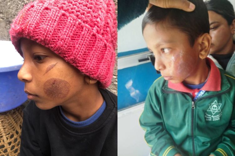 हो–हल्ला गरेको भन्दै शिक्षिकाले तातो पन्युले तीन विद्यार्थीको गाला डामिन्